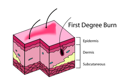 1st degree burn baby 1st degree burn baby