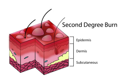 Second degree burns are more serious than first degree burns, but less serious than third degree burns. They can cause serious discomfort. Contact a qualified Houston burn lawyer today to discuss your burns, and remember to get medical attention immediately.