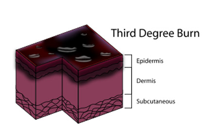 Third degree burns can be extremely severe and can require painful operations and skin grafts. Contact an experienced Houston personal injury attorney or burn injury lawyer now to discuss your options. 