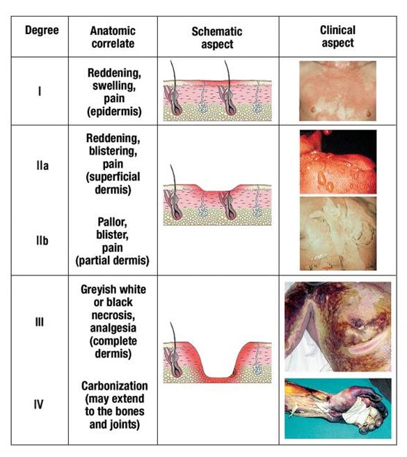 2nd degree burn wound care 2nd degree burn wound care